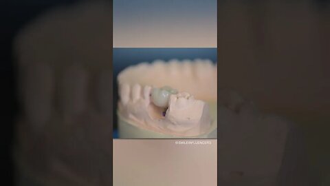 Tooth Implant Crown (DENTAL PHOTOGRAPHY)