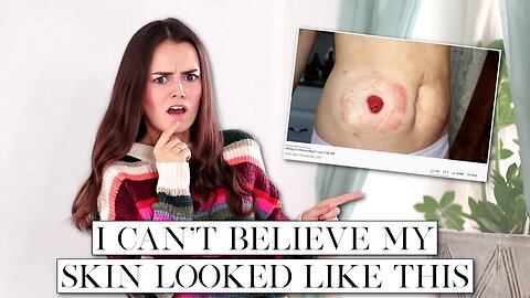 How I Healed the Skin Around My Stoma | Let's Talk IBD