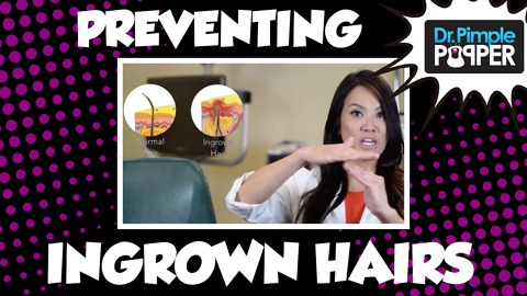 Preventing Ingrown Hairs