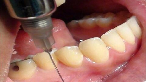 Warning: Dentist Intramuscular Analgesics are Administering Graphene-Oxide