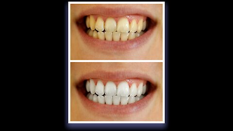 Whitens Teeth Up To 6 Shades In Less Than 16 Minutes.