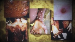 Risk of monkeypox infection remains low, state health officials say