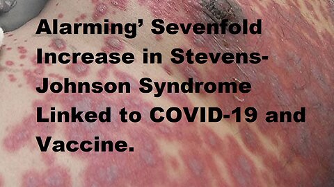 'Alarming' 7-Fold Increase in Stevens–Johnson Syndrome Linked to COVID-19 and Vaccine