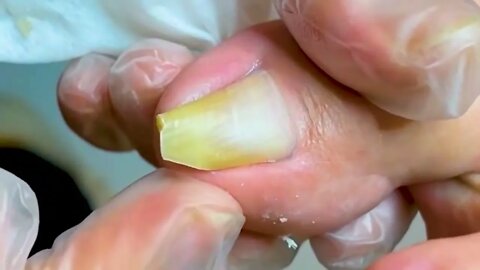 Manicure Unclogging the toenail Solve your problem #16 | 2022 Video