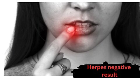 Herpes negative and we did another follow up one year later.