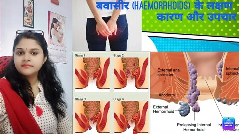 What is the main cause of #hemorrhoids? and its treatment. #बवासीर #drminakshisingh #homeopathy