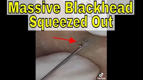 MASSIVE Blackhead squeezed out! #blackheadremoval #blackhead #blackheads #fypage #fyp #fypviral