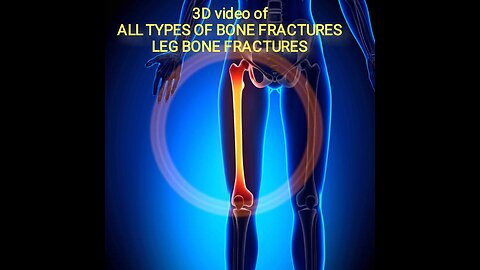 3D video | Types of bone fractures | Leg bone fracture | bone fractures