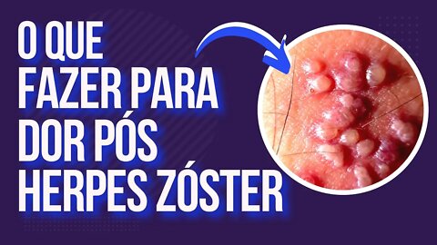 Herpes Zóster - Tratamento Para Dor Pós Herpes Zóster
