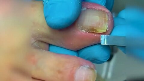 Manicure Unclogging the toenail Solve your problem #8 | 2022 Video