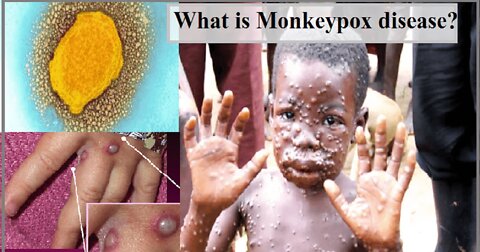 MONKEY POX, VACCINES, AND BOOSTERS GET READY