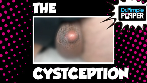 The CystCeption