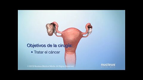 Opciones de tratamiento para el cáncer de ovario