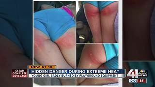 Young girl burned by playground equipment