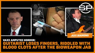 Vaxx Amputee Horror: Guitarist Loses Fingers, Riddled With Blood Clots After The Bioweapon Jab