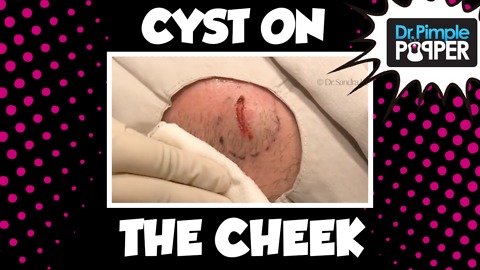 Is it a Duck or a Dodger Cyst?