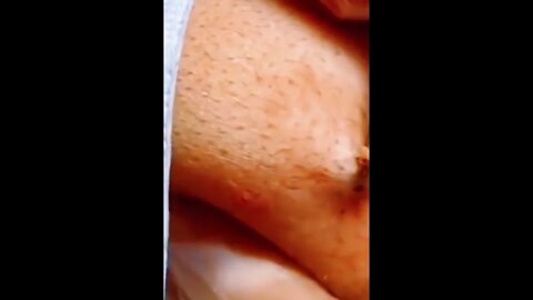 Huge Blackhead Removal