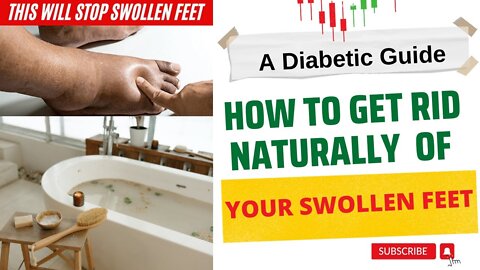 Home Remedies for Swollen Feet | Edema Remedy | Diabetes
