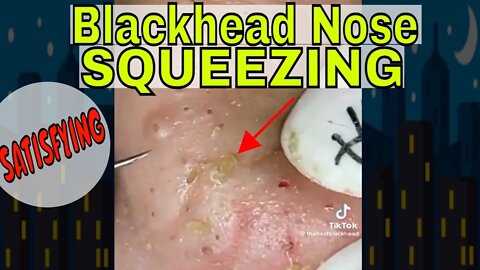 Satisfying Blackhead Nose Squeezing 🪱 #blackheadremoval #blackhead #blackheads #squeezing