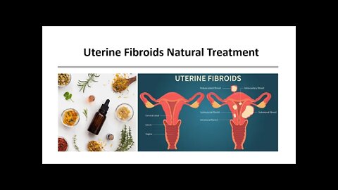 Uterine Fibroids Natural Treatment