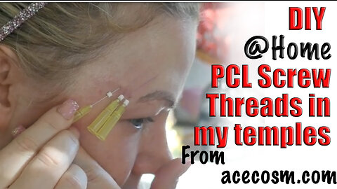 DIY @ Home PCL Screw Threads in my Temples | Wannabe Beauty Guru