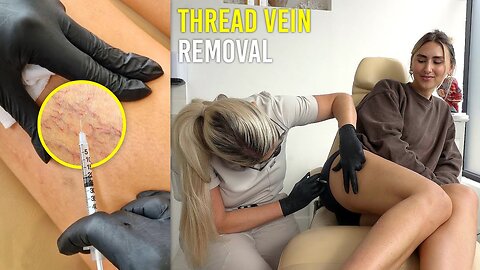 How To Remove Thread Veins (Pain Free)