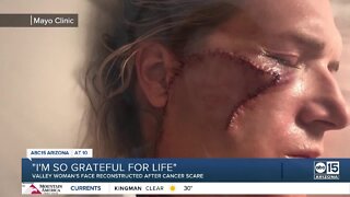 Valley woman's face reconstructed after cancer scare