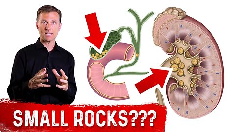 Why Do Stones Develop In Your Kidney and Gallbladder?
