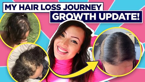 Update On My Hair Loss Journey (+ Hair Growth Tips That No One Knows!)