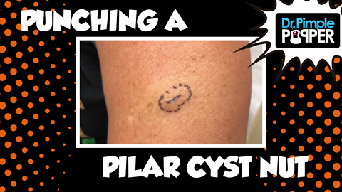 Punching a Pilar Cyst Nut
