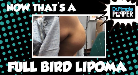 Now That's a FULL BIRD Lipoma!