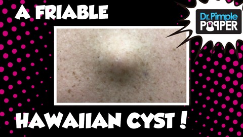 A Friable Hawaiian Cyst 🌺