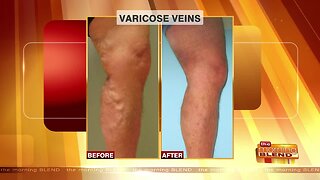 Exploring Vein Issues, Symptoms, and Solutions