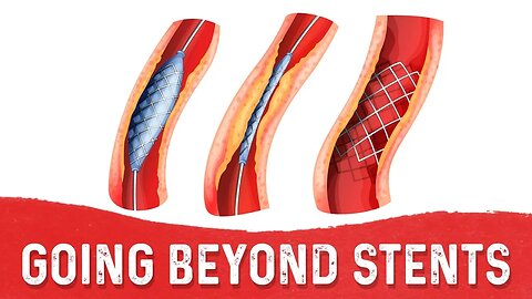 Stents May be the Patch, But Whats the Fix? – Dr.Berg
