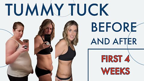 Tummy Tuck Before and After- First 4 weeks- Skin Removal After 100+ Pound Weight Loss