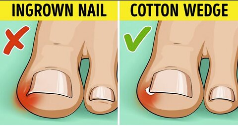 Effective Ways to Fix Ingrown Toenails...