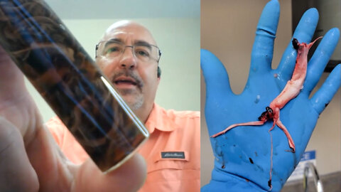 Mortician makes shocking discovery of rubber-band like objects inside the “vaccinated”