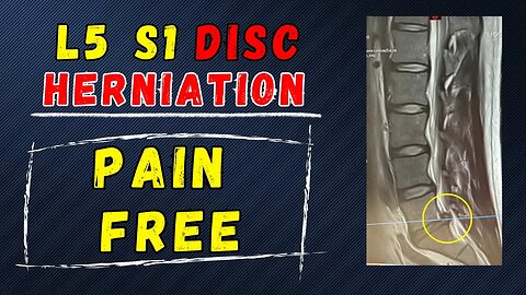 L5 S1 Disc Herniation Recovery without surgery