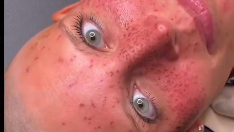 YOU WILL NEVER GUESS WHAT GEN Z IS GETTING TATTOOED ON THEIR FACES...LOOKS LIKE ACNE OR THE POX