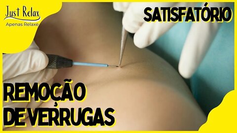 Remoção de Verrugas com Plasma - Satisfatório Verrugas com Plasma Asmr - Just Relax | Apenas Relaxe