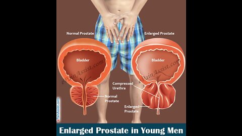 Best Supplements to Eat for Prostate