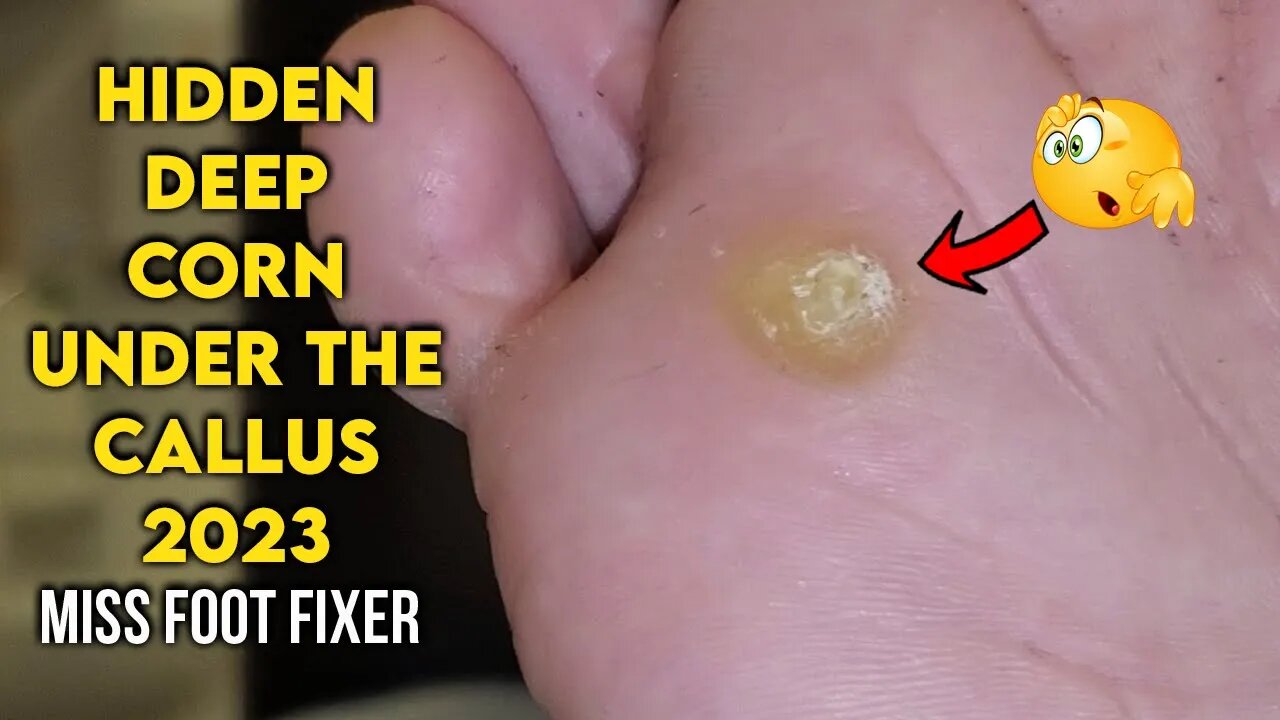 SATISFYING THICK FOOT CALLUS REMOVAL BY MISS FOOT FIXER MARION YAU 