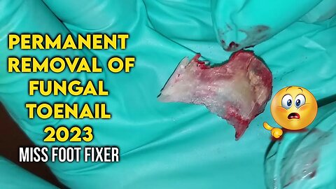 PERMANENT REMOVAL OF FUNGAL NAIL [ DAMAGED NAIL ] BY FAMOUS PODIATRIST MISS FOOT FIXER