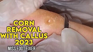 CORN REMOVAL WITH CALLUS - 🦶 [ FOOT DOCTOR MISS FOOT FIXER TREATMENT 2023]