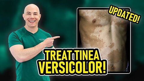 How to Treat Tinea Versicolor and Keep it From Coming Back (Dermatologist Updated 2023!)