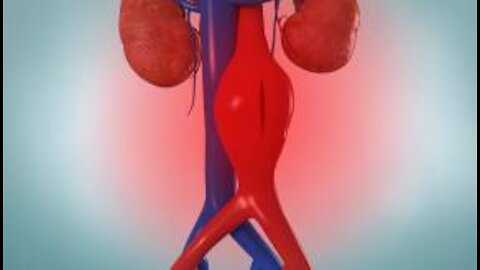 what is aortic aneurysm?