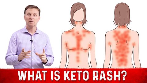 What is Keto Rash? - Dr. Berg