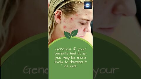What causes Acne And It's Treatment #acne #acnetreatment #acnescars #acneremoval