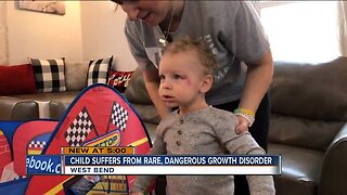 Child suffers from rare, dangerous growth disorder