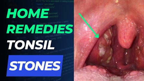 7 Home Remedies For Tonsil Stones